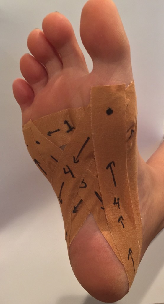 Plantar Fasciitis Treatment How to Heal Heel Pain