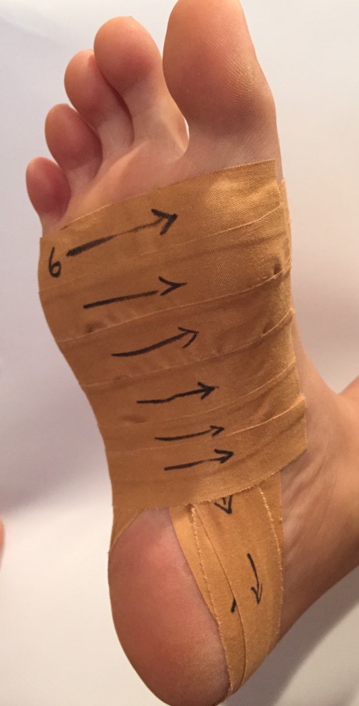 Plantar Fasciitis Treatment How to Heal Heel Pain