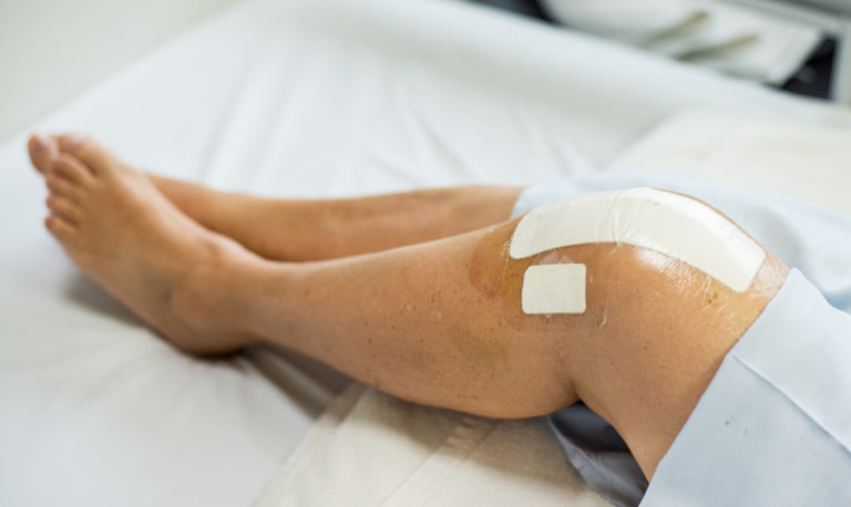 Total Knee Replacement Recovery: What to Expect After Knee Replacement