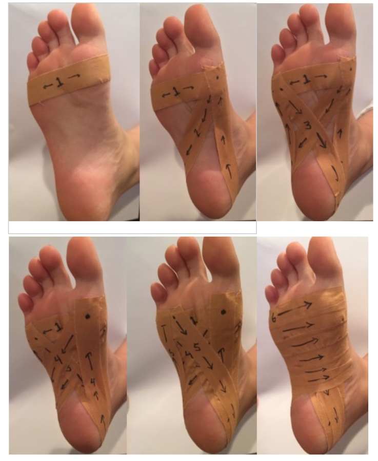 plantar fasciitis strapping