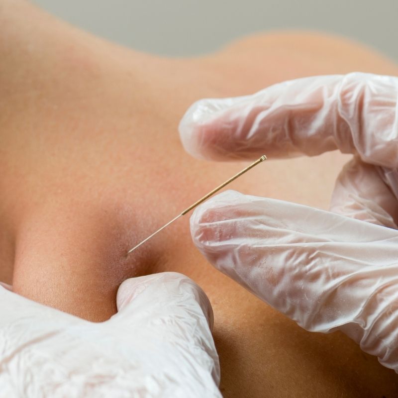dry needle procedure