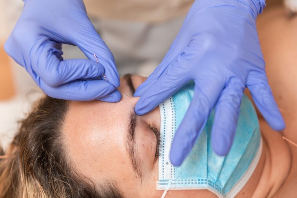 dry needling for headaches